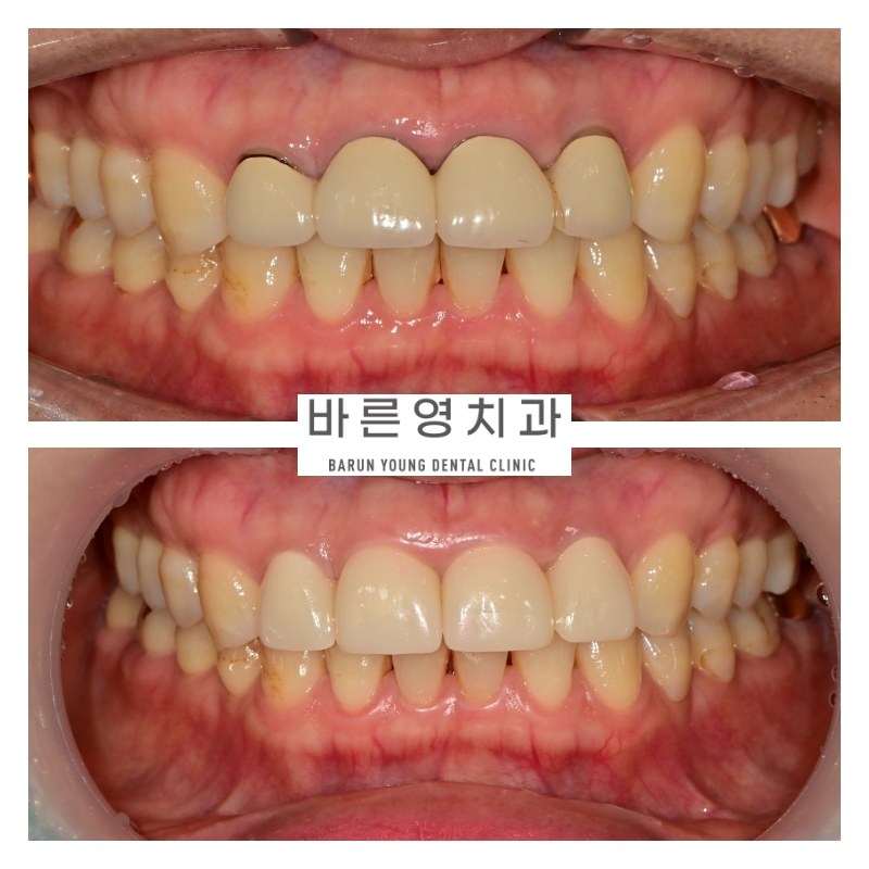 비율이 맞지 않는 앞니 · 재신경치료 후 재보철 — 바른영치과의원