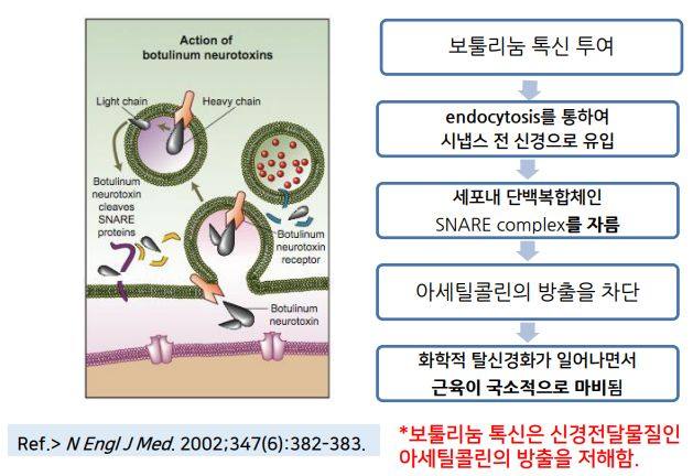 약수역치과, 턱관절 관련 질환(보톡스 치료) 사진 1