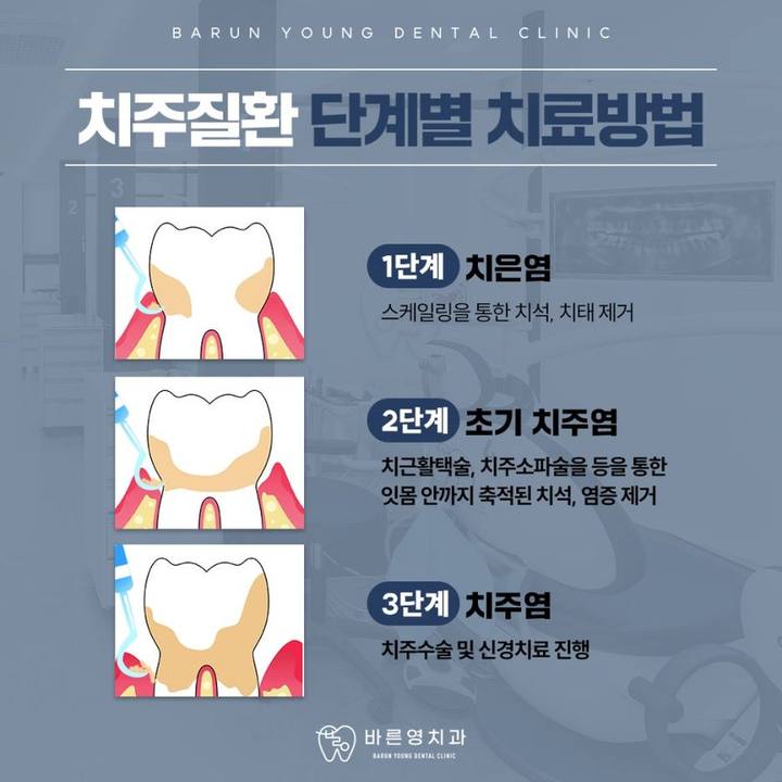 옥수동치과, 풍치라 불리는 치주질환 치료시기가 중요한 이유 사진 13