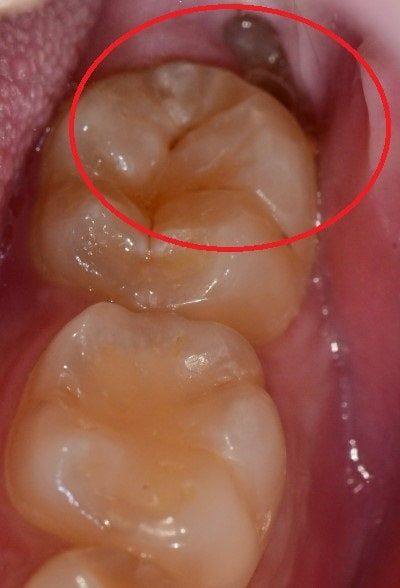 금호동 치과, 사랑니 때문에 주변 잇몸이 붓는 이유 (매복 사랑니 주변 치은염) 사진 2
