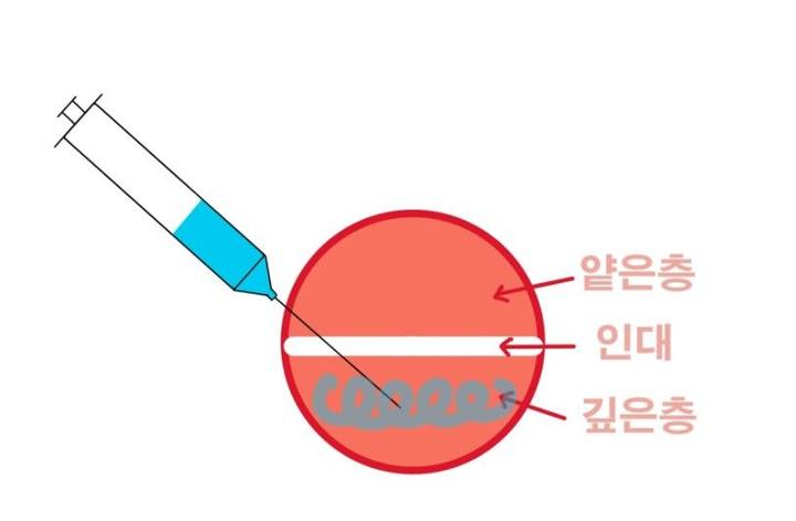신당동 치과, 턱 보톡스 주사 이후에 나타날 수 있는 증상 ( 사각턱, 저작근, 볼 알사탕 현상) 사진 5