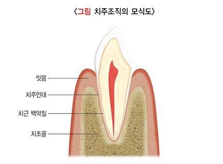 약수동 치과 내려앉은 잇몸 공간 치아삭제 없이 치료하기 사진 1