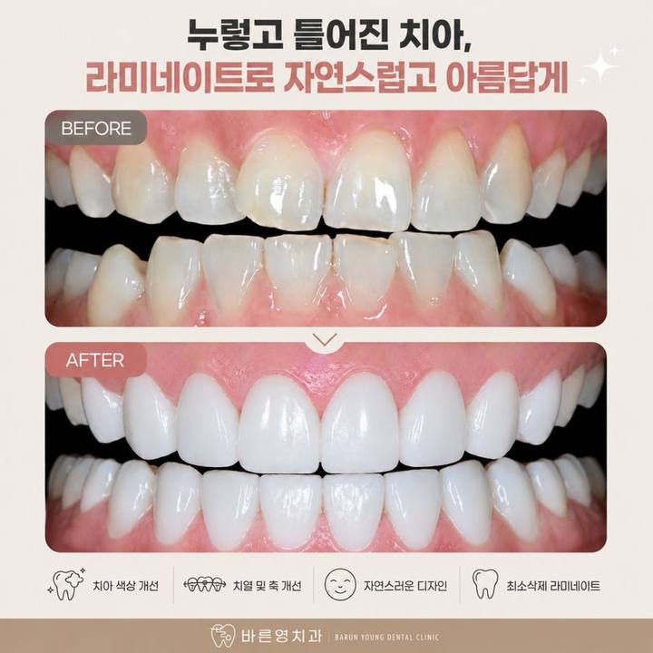 약수역 치과 라미네이트 vs 올세라믹, 어떤 치료가 더 좋을까요? 사진 1