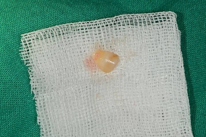 약수역 치과 크랙 치아 (금 간 치아) 사진 2