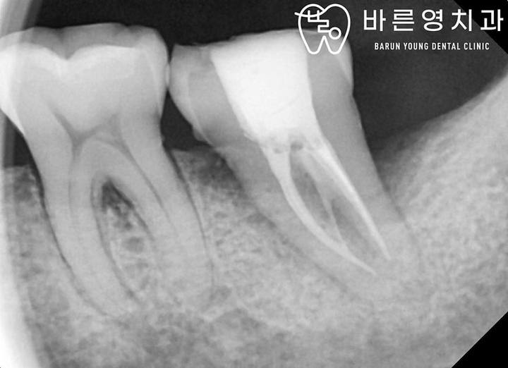 바른영치과 신경치료 사례