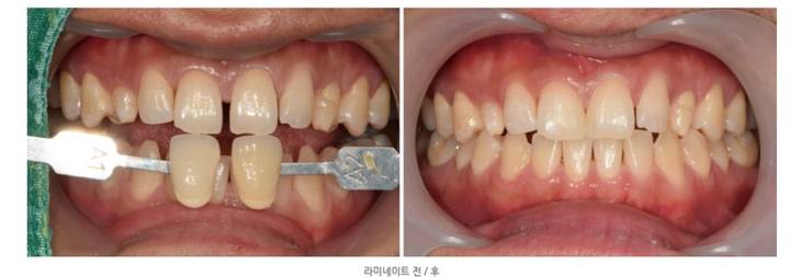 약수역 치과 , 전치부 심미보철 재제작할때 주의할 점 ( 항상 무삭제 라미네이트가 가능한 것인가??) 사진 5