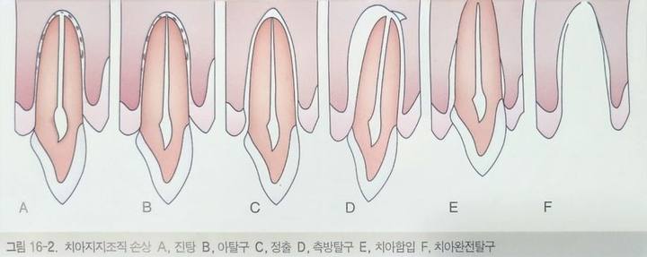 약수역 치과, 넘어지거나 외상에 의한 치아 파절 시 흔들리는 치아 치료하는 방법 ( 심미보철, 신경치료, 치아 고정술) 사진 1