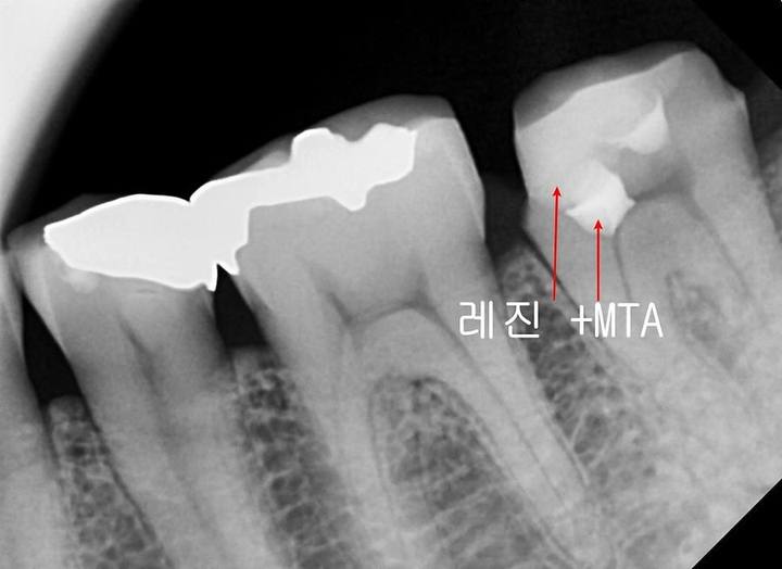 장충동 치과, MTA를 이용한 신경치료 시 주의할 점( 크랙치아, 깊은 충치) 사진 9
