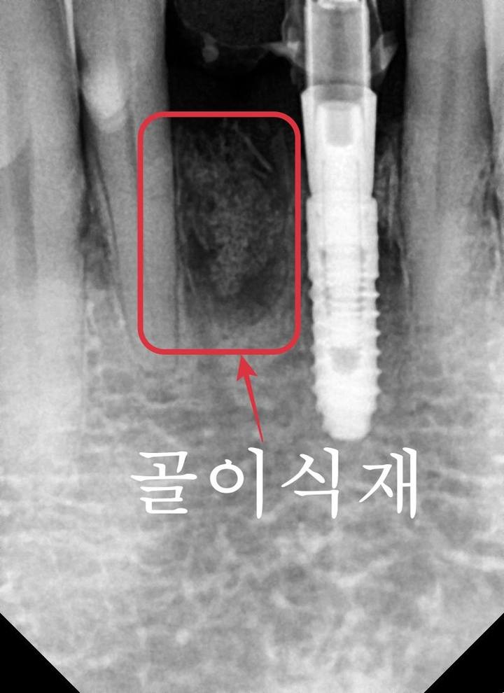 성동구 옥수동 치과 앞니 임플란트수술 즉시 임시치아 제작(구강스캐너를 이용한 수술절차) 사진 7