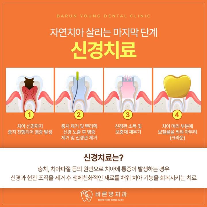 옥수동치과, 충치치료와 신경치료로 자연치아 보존하기 사진 8