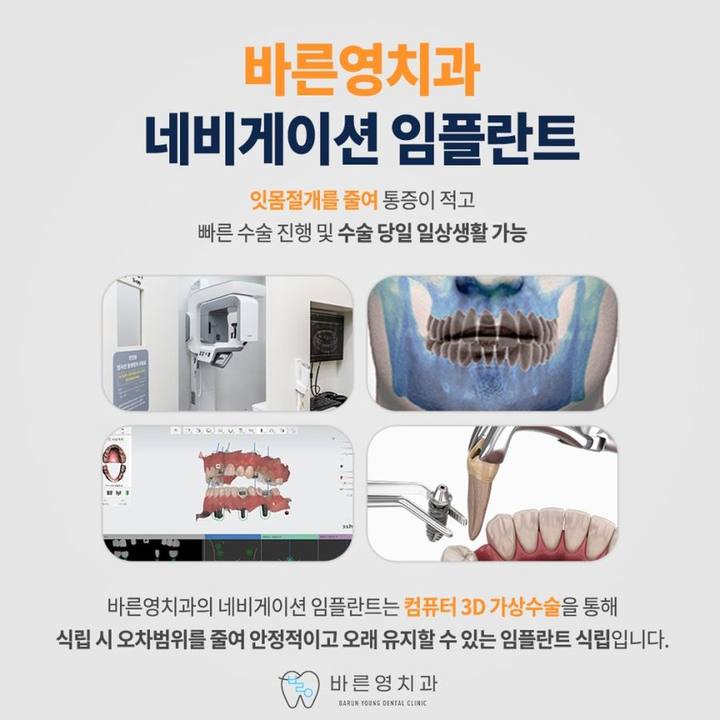 약수역치과 네비게이션 임플란트로 잃어버린 치아 대신 사진 9