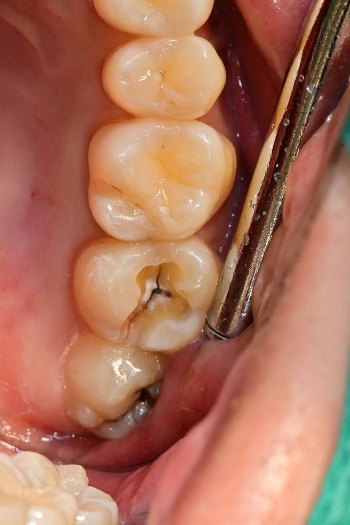 치료 전 / 후