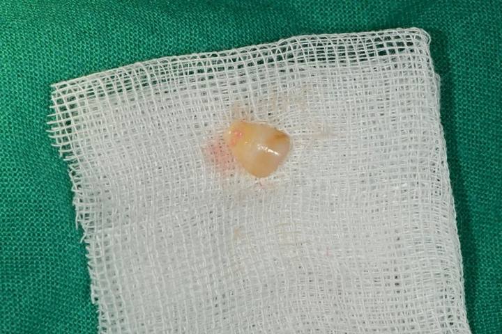 금호역 치과, 파절(크랙치아) 치료 이후 임플란트 치료가 필요한 경우 사진 4