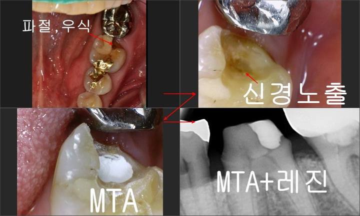장충동 치과, MTA를 이용한 신경치료 시 주의할 점( 크랙치아, 깊은 충치) 사진 11