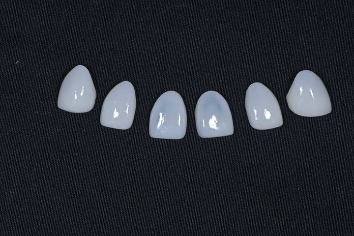 동대문 무삭제라미네이트 과거 교정한 치아가 웃을 때 안 보여 스트레스일 때 사진 5