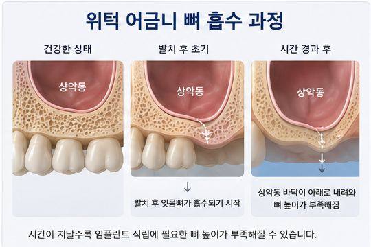 약수역 치과, 임플란트 상악동 거상술, 꼭 필요한 경우는? 사진 2