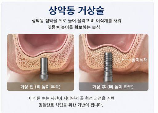 약수역 치과, 임플란트 상악동 거상술, 꼭 필요한 경우는? 사진 3