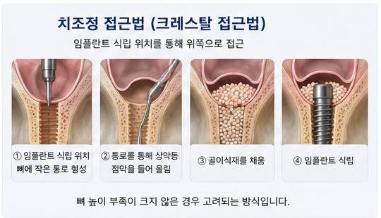 약수역 치과, 임플란트 상악동 거상술, 꼭 필요한 경우는? 사진 5