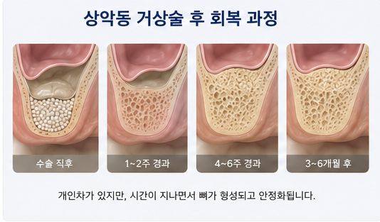 약수역 치과, 임플란트 상악동 거상술, 꼭 필요한 경우는? 사진 7