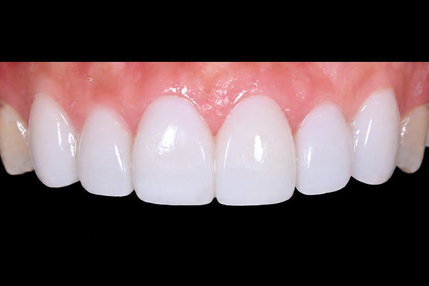 치아 모양 색상 개선 사례 — 라미네이트 치료 후