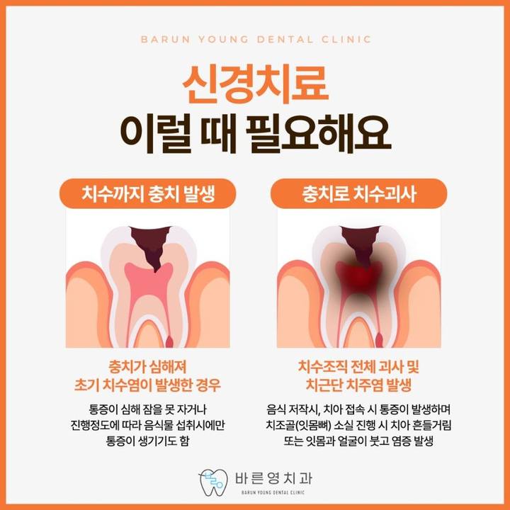 약수역치과, 충치 방치하면 할수록 치료 난이도는 올라갑니다. 사진 7