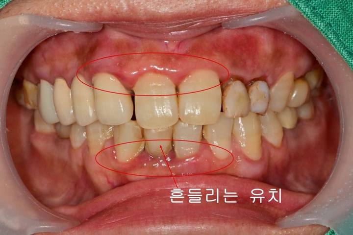 옥수동 치과, 성인유치 결손치 부분 앞니 보철, 임플란트 가능한가요 사진 2